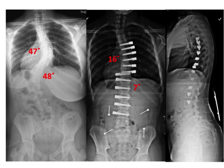 Non-fusion Corrective Scoliosis Surgery - Scoliosis And Spine Associates