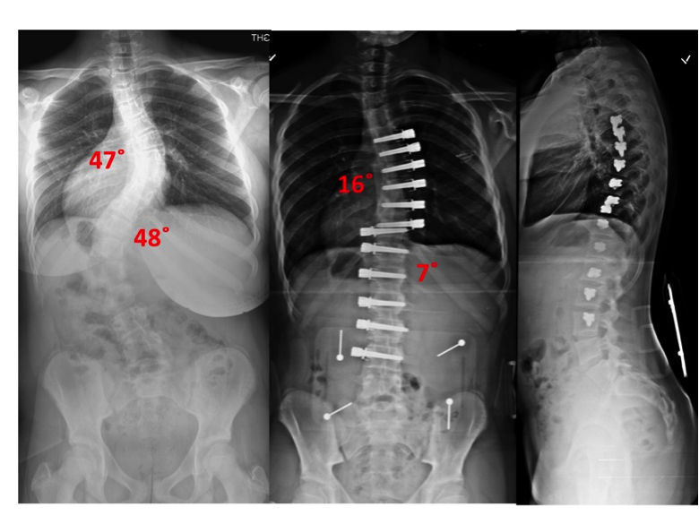 Scoliosis Bracing and Untold Benefits Associated With It