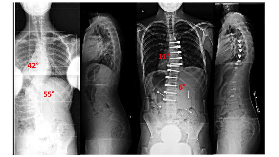 scoliosis surgery fusion vbt thoracolumbar correction corrective thoracic non near left spine treatments treated patient right young story