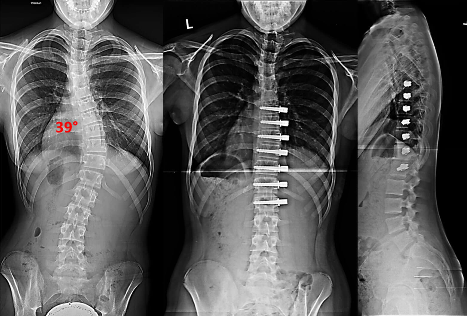 Lumbar Scoliosis Surgery 