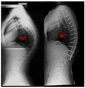 Scheuermann’s Kyphosis - Scoliosis And Spine Associates