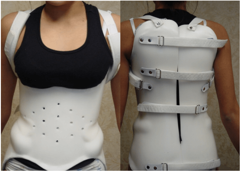 Full Body Orthosis Braces  Back Brace for Posture, Scoliosis & More